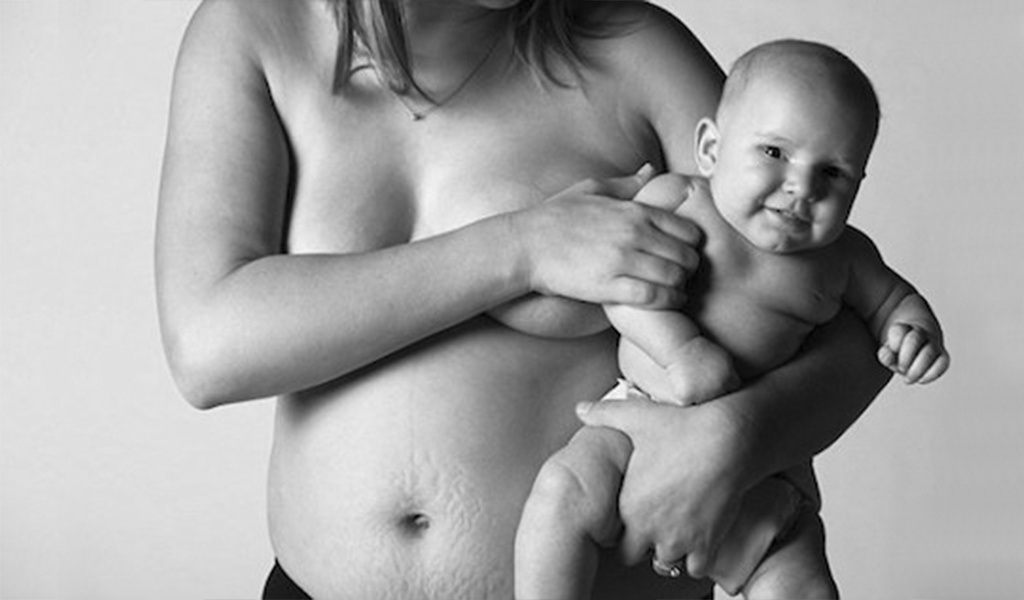 Las hermosas e imperfectas cicatrices de ser madre